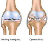 Protocol GMB - Relieve Joint Pain